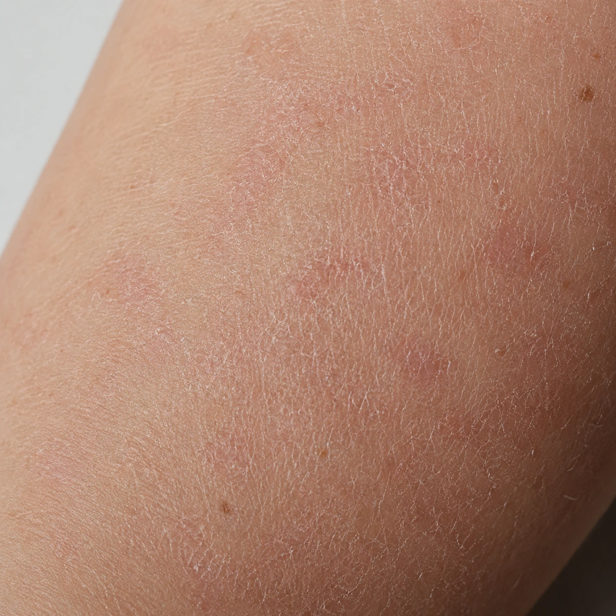Before — dry, itchy or irritated skin