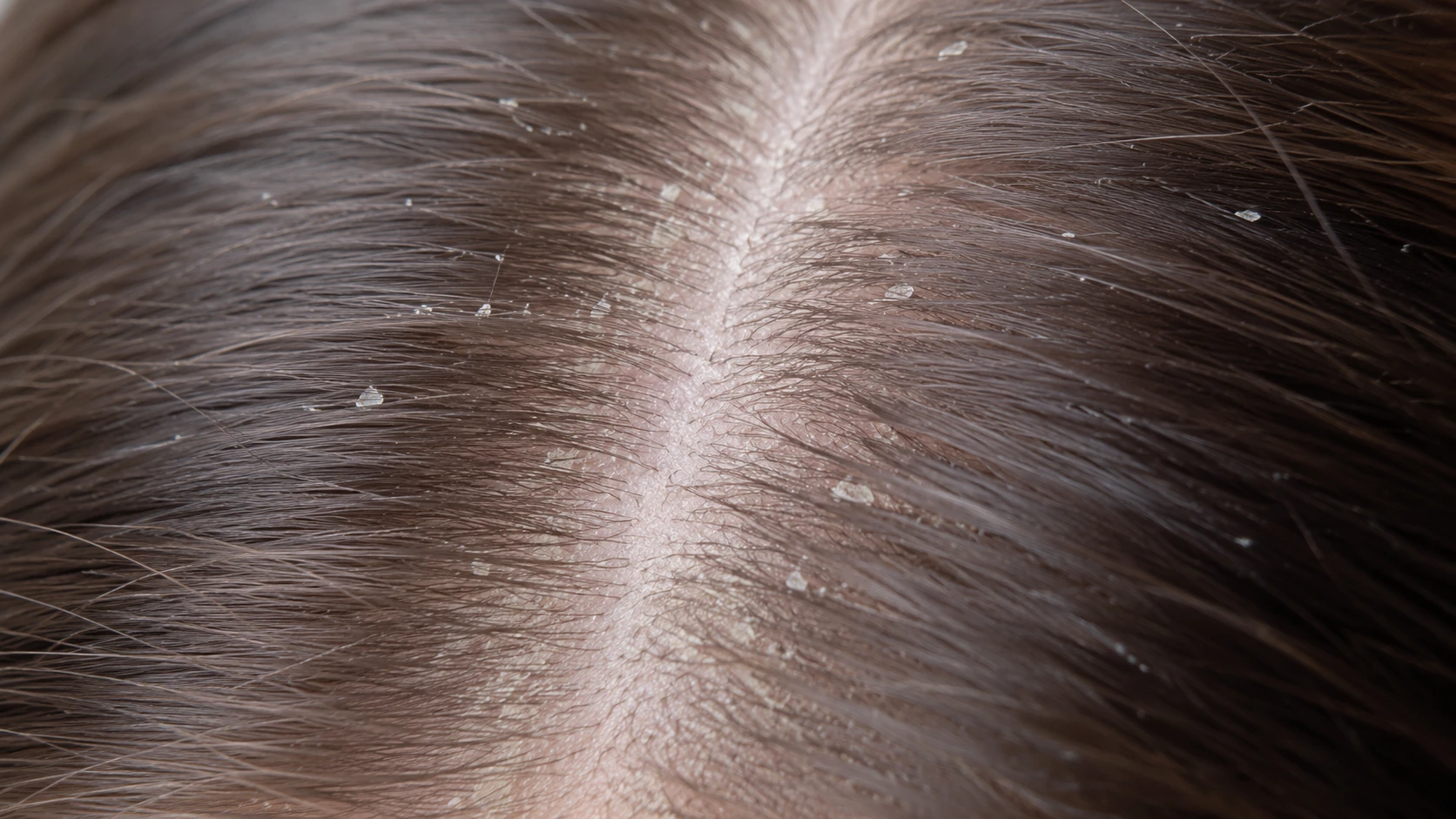 Before — dry, itchy and flaky scalp