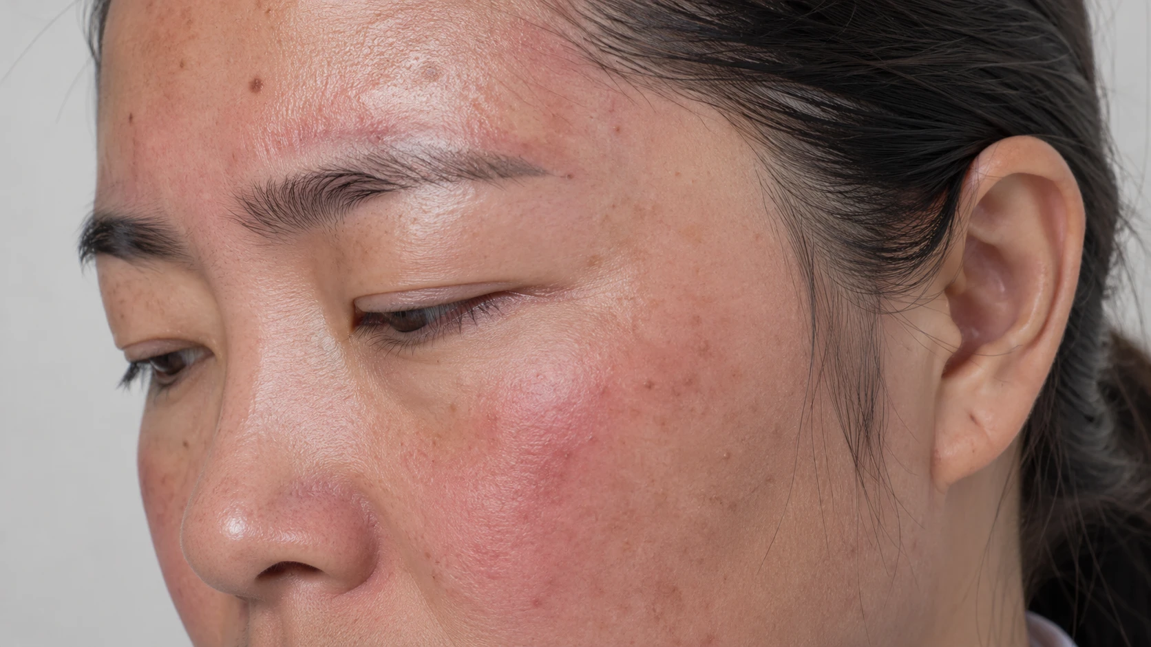 Before &mdash; skin reactive and easily flushed after sun exposure