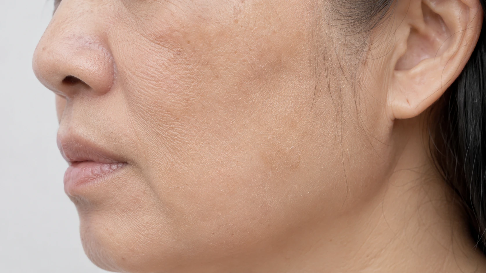 Before &mdash; dry, dehydrated skin with visible rough texture from daily UV exposure