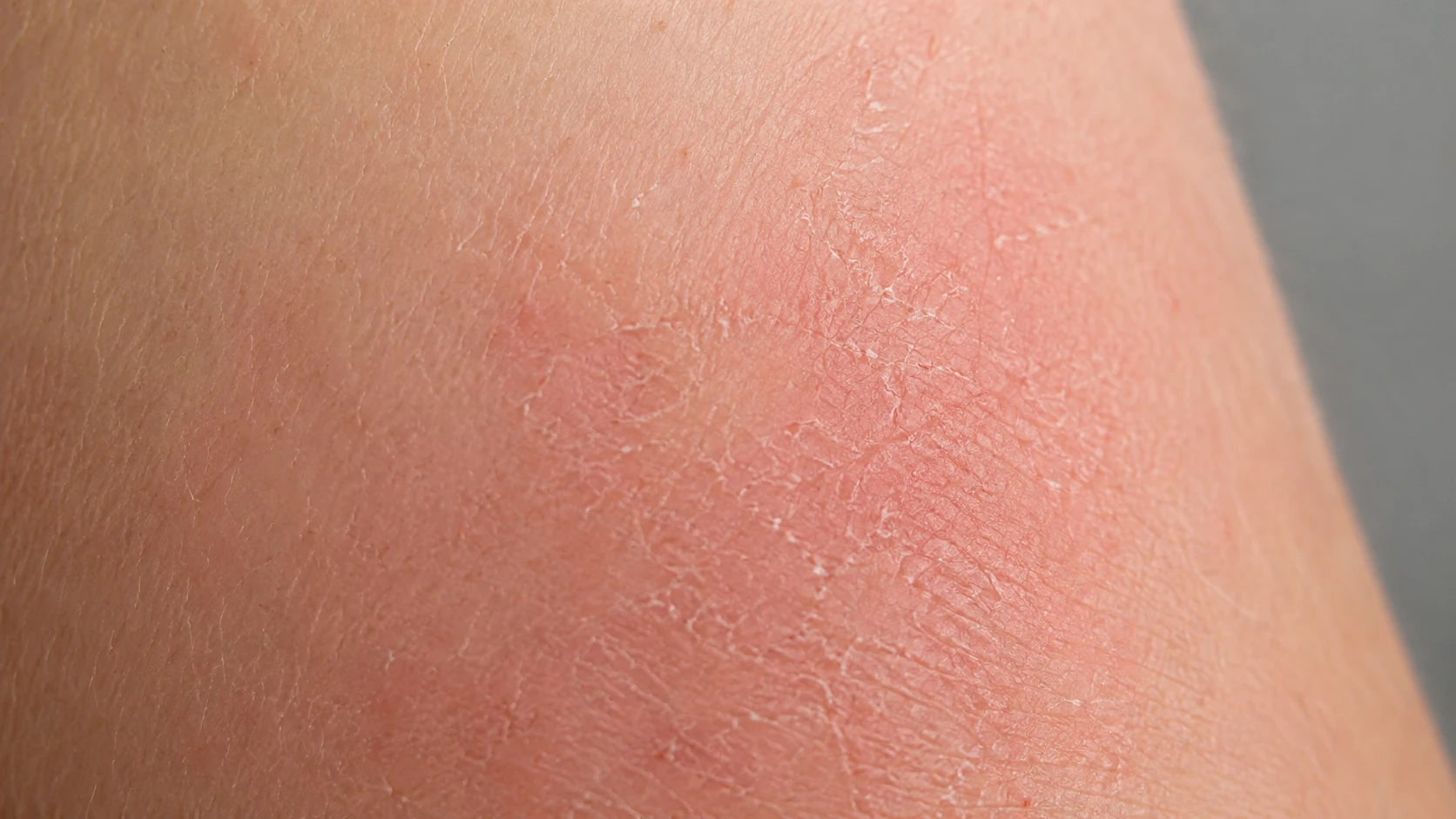 Before: dry irritated skin after conventional soap-based cleansing