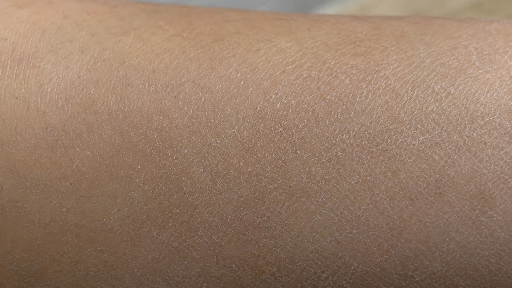 Before: dry dull skin before using REMDII Multi-Vitamins Daily Lotion